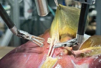 Pela 1ª vez na história, robô faz cirurgia guiado por IA sem ajuda humana
