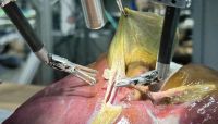 Pela 1ª vez na história, robô faz cirurgia guiado por IA sem ajuda humana