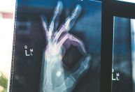 Ossos têm função endócrina: por que é importante prevenir osteoporose