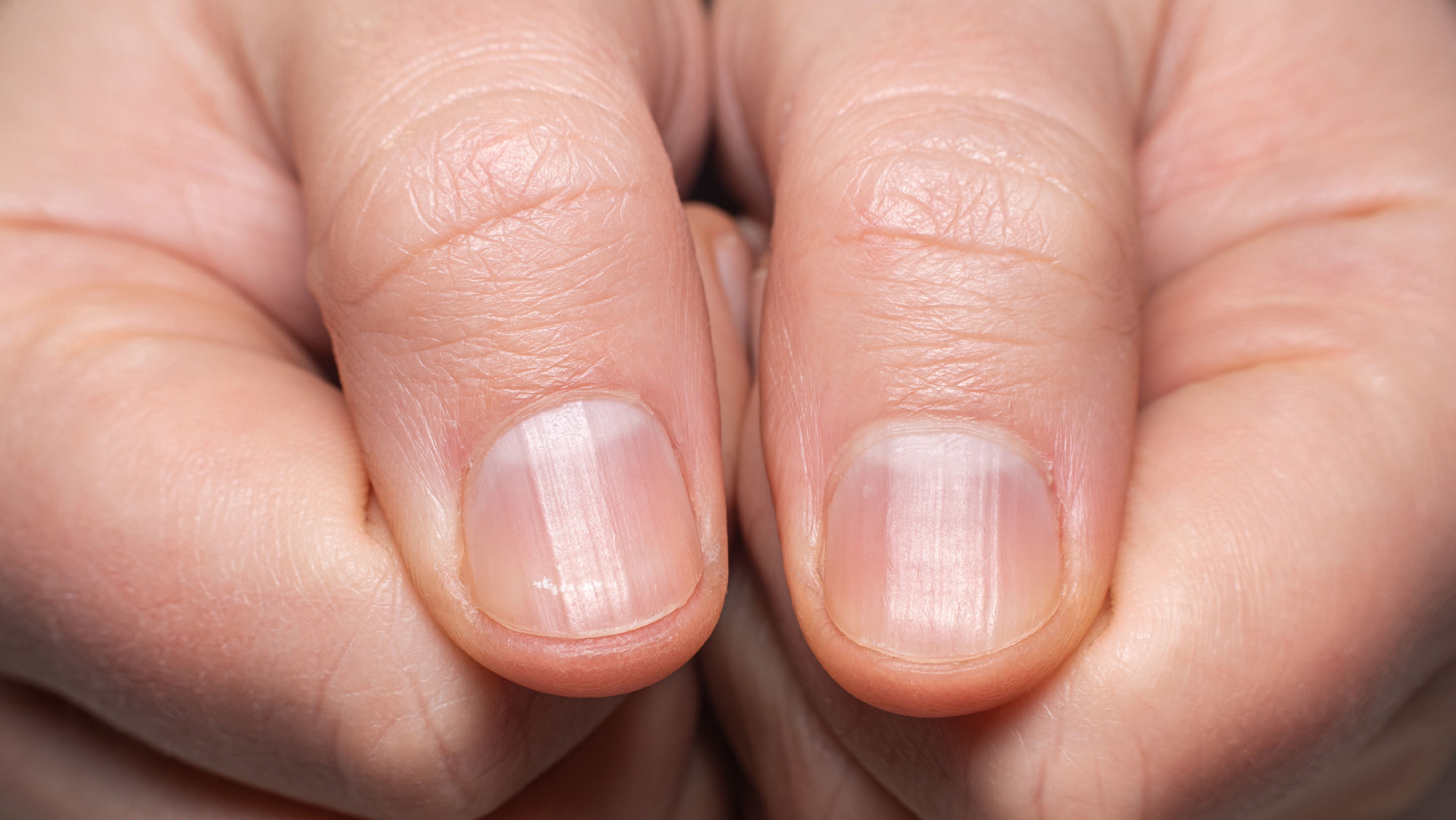 Unhas estriadas: o que pode ser e como tratá-las | CNN Brasil