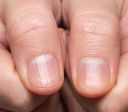 Unhas estriadas: o que pode ser e como tratá-las