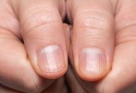 Unhas estriadas: o que pode ser e como tratá-las