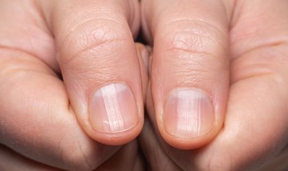 Unhas estriadas: Dermatologista explica o que pode ser e como tratá-las