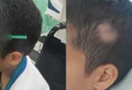Criança fica com lápis cravado na cabeça após briga em escola de SP