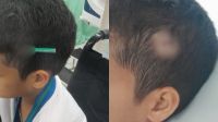 Criança fica com lápis cravado na cabeça após briga em escola de SP
