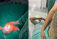 Hospital de SC tem dois partos raros de gêmeos empelicados: "Pai desmaiou"