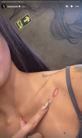 Bia Miranda mostra ferimento de acidente de trânsito • Instagram/Bia Miranda