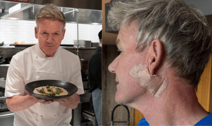 Gordon Ramsay passa por procedimento após diagnóstico de câncer de pele