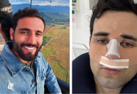 Ex-BBB Matteus Amaral mostra resultado de cirurgia no nariz: "Estranho"