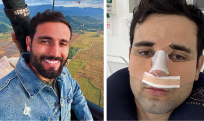 Ex-BBB Matteus Amaral mostra resultado de cirurgia no nariz: "Estranho"