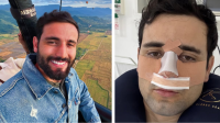 Ex-BBB Matteus Amaral mostra resultado de cirurgia no nariz: "Estranho"