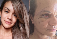 Mulher agredida com 60 socos mostra o rosto após cirurgia, veja a foto