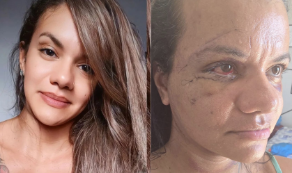 Mulher agredida com 60 socos mostra o rosto após cirurgia, veja a foto