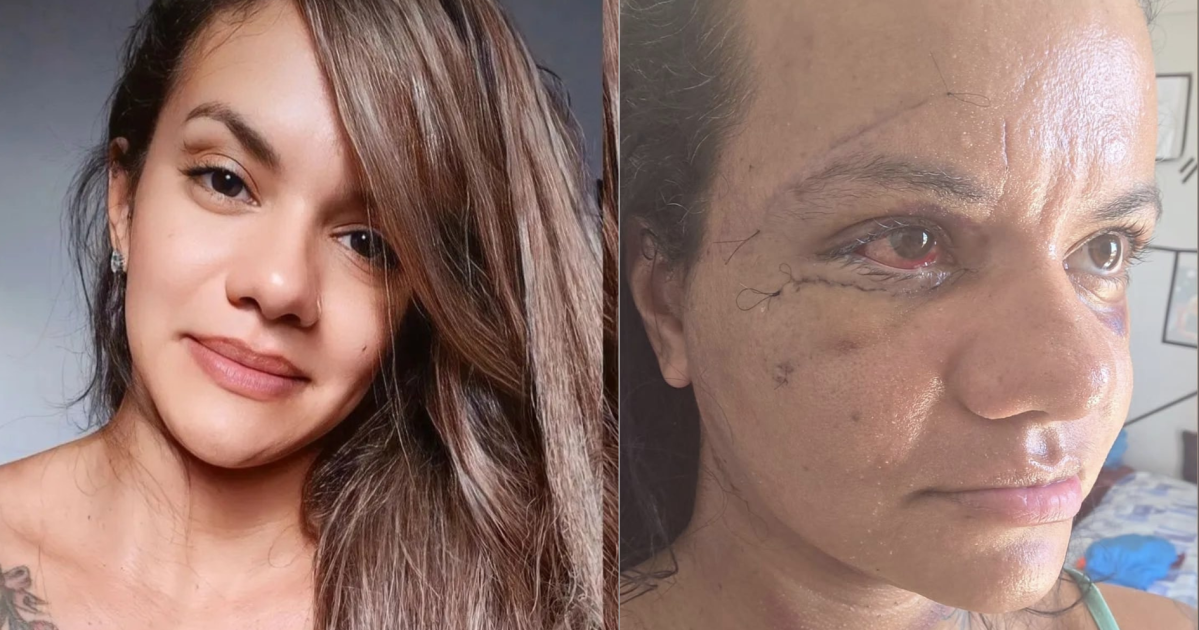 Mulher agredida com 60 socos mostra o rosto após cirurgia, veja a foto ...