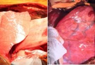 Pulmão de porco modificado é transplantado em homem pela 1ª vez