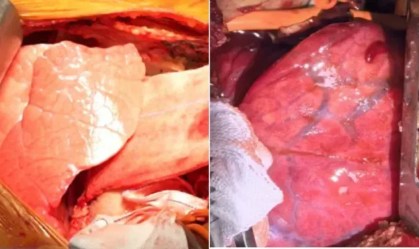 Pulmão de porco modificado é transplantado em homem pela 1ª vez