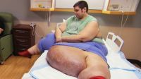 "Quilos Mortais": como está J.T., que pesava 404 kg e tinha linfedema grave
