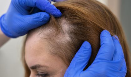 Alopecia areata: impacto mental é maior do que a gravidade da doença