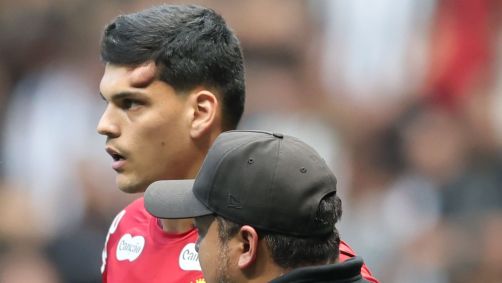 Gabriel Brazão com inchaço impressionante após choque em Atlético-MG x Santos