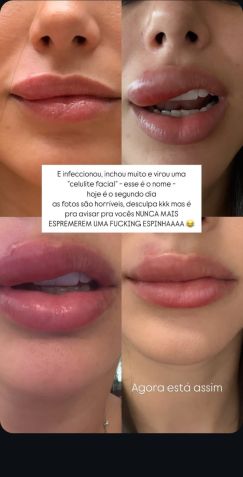 Biancardi compartilhou nos stories a evolução da celulite facal em sua boca • Instagram / Bruna Biancardi