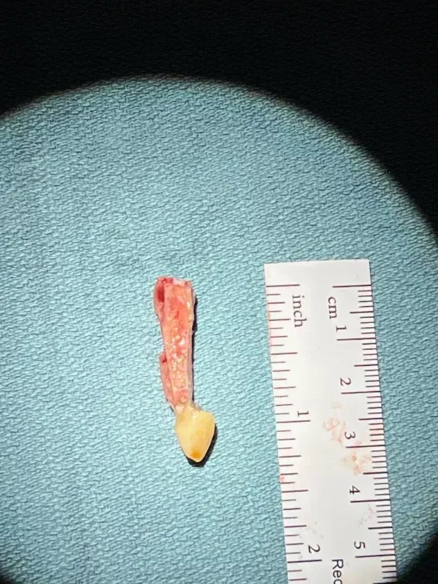 Um dente canino ressecado com uma fina camada de osso • Arquivo pessoal