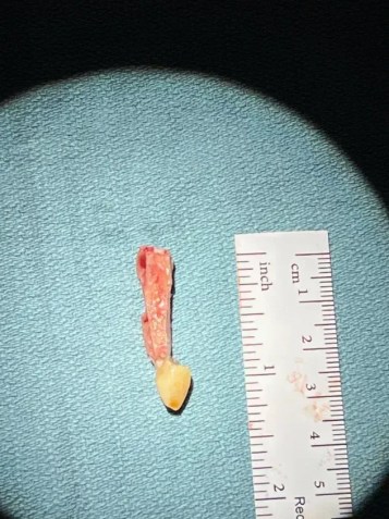 Um dente canino ressecado com uma fina camada de osso • Arquivo pessoal