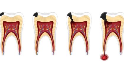 Exercício físico e ômega-3 ajudam a reduz gravidade de infecção dental