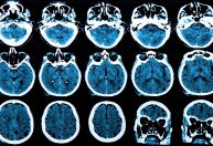 Terapia genética pode reduzir progressão da doença de Huntington