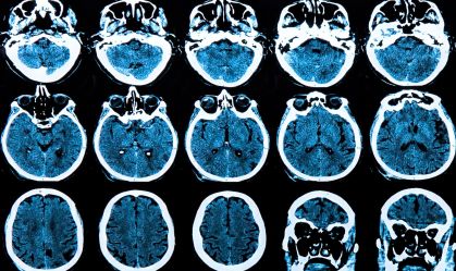 Terapia genética pode reduzir progressão da doença de Huntington