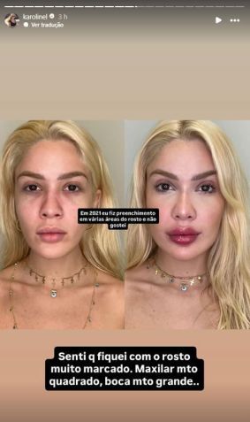 Karoline Lima mostrou antes e depois de procedimentos estéticos • Instagram/Karoline Lima