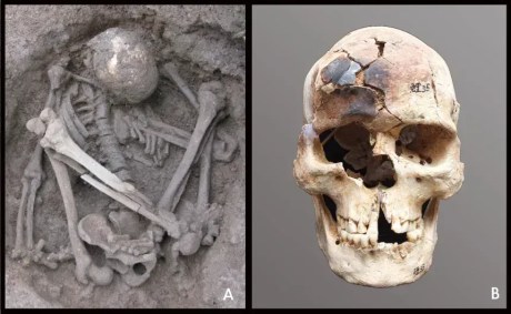 Datado de cerca de 7.000 anos atrás, o esqueleto fortemente dobrado de um jovem (à esquerda) foi encontrado no sítio arqueológico de Liyupo, no Condado de Longan, em Guangxi. O crânio estava parcialmente queimado