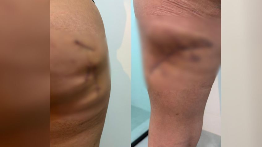 The model had part of the skin tissue removed in surgery • Reproduction