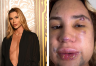 Fox eyes: entenda procedimento que vitimou influenciador digital