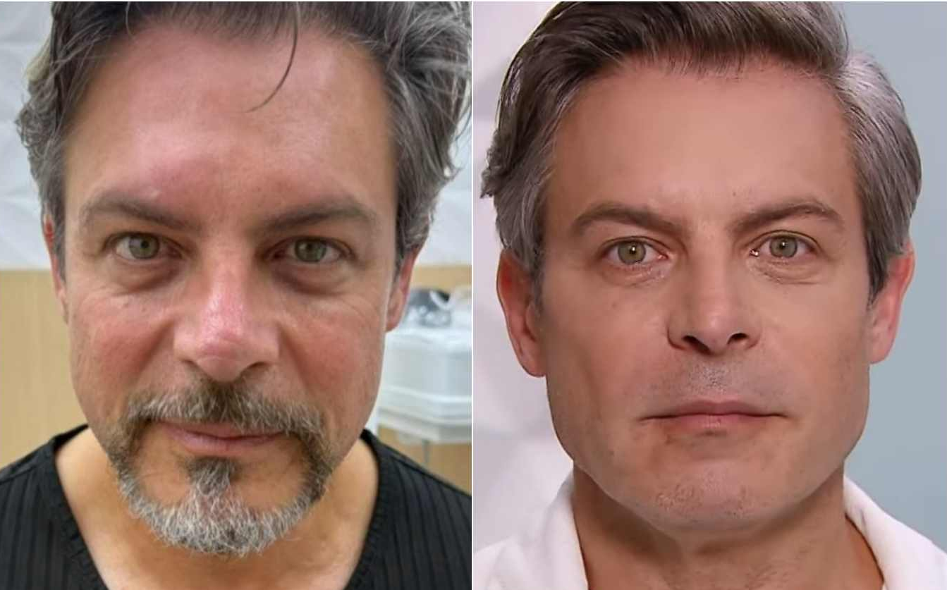 O antes e depois da harmonização facial de Luigi Baricelli • Reprodução/SBT