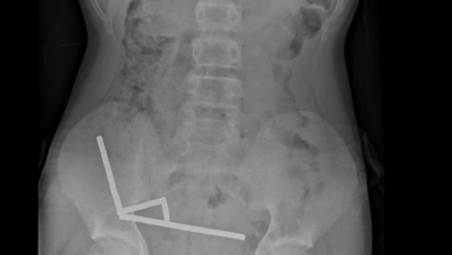 Adolescente perde parte do intestino após engolir mais de 80 imãs | CNN Brasil
