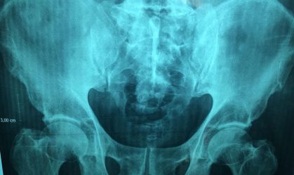 Por que a população precisa se preocupar com a osteoporose?