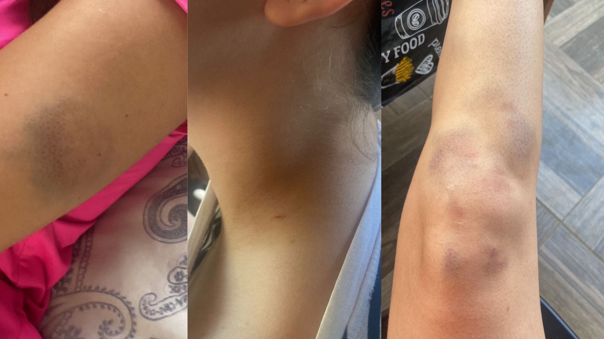 Fotos mostram marcas de agressões no corpo da vítima • Reprodução