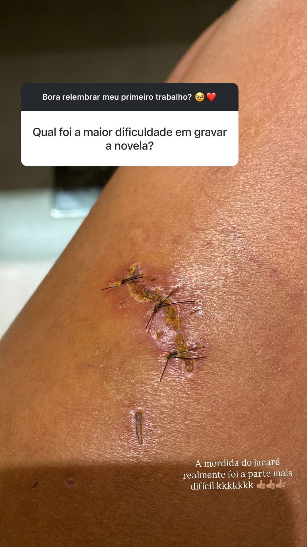 Bella Campos posta foto de mordida de jacaré • Instagram/ Bella Campos
