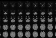 Cientista traduz pensamentos em palavras usando ressonância magnética