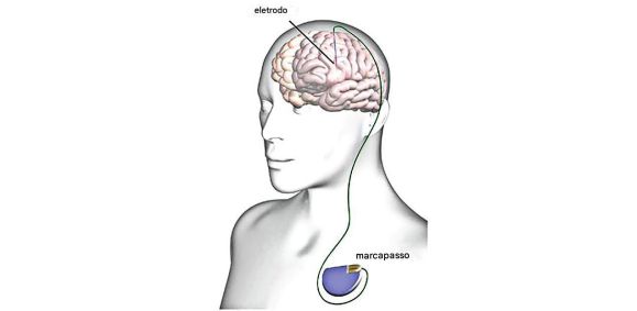 configuração-típica-de-estimulação-cerebral-profunda