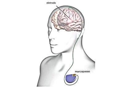 Implantes cerebrais melhoram 50% dos casos resistentes de depressão