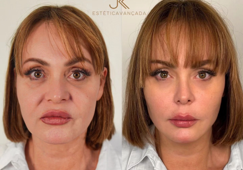 Gaby Spanic faz harmonização facial e resultado choca fãs • Instagram / Gaby Spanic