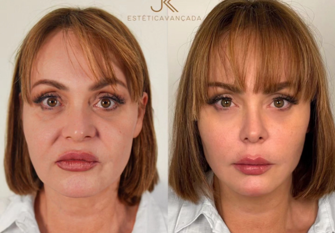 Gaby Spanic faz harmonização facial e resultado choca fãs • Instagram / Gaby Spanic