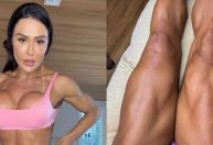 Gracyanne Barbosa mostra cicatrizes de cirurgia: "Marcas de vitória"