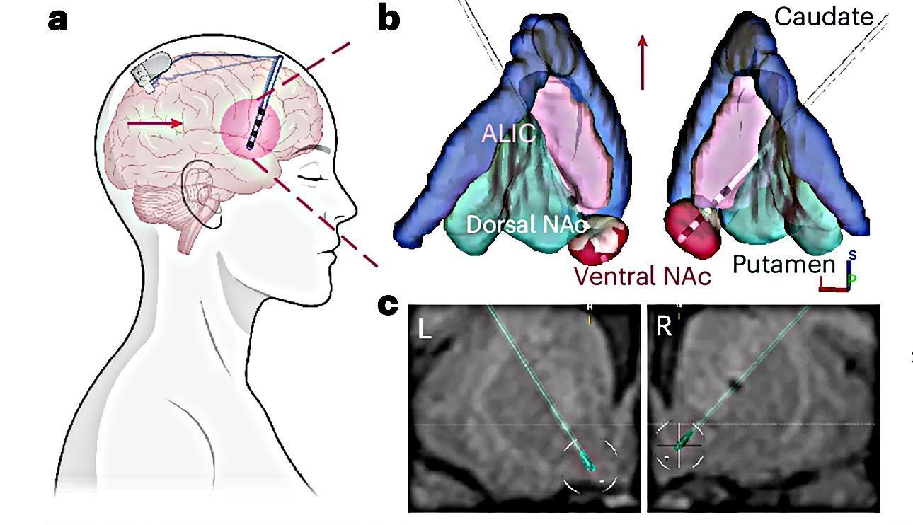 Representação artística dos dois eletrodos de profundidade colocados no núcleo accumbens da participante e imagens de ressonância magnética • Wonkyung Choi et al., Nature Medicine, 2025/Reprodução
