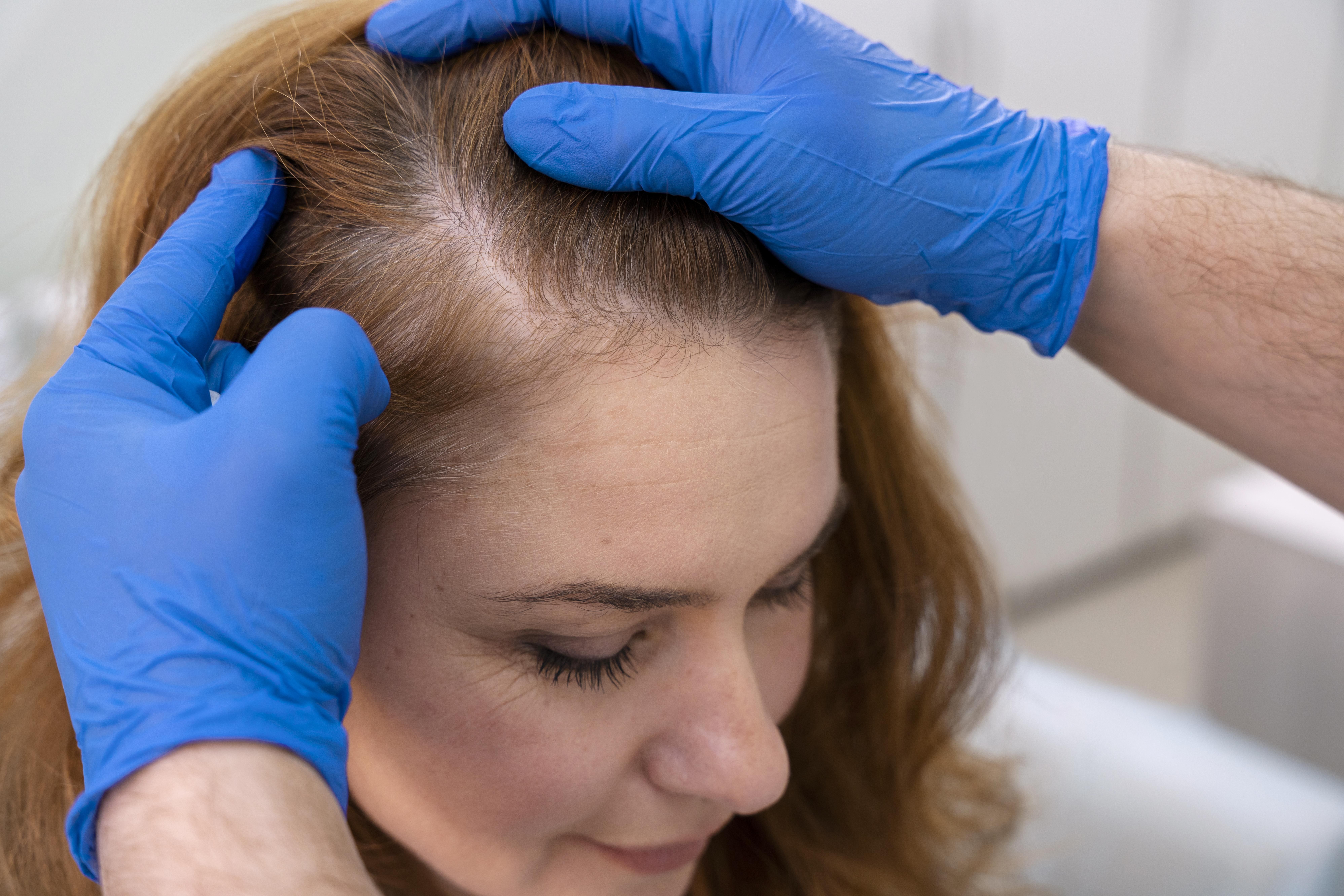 Procedimentos de transplante capilar em mulheres nem sempre surtem os efeitos necessários