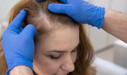Transplante capilar para mulheres está em alta e taxa de sucesso é complexa