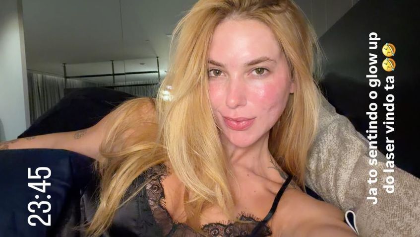 Virginia faz procedimento a laser para tratar espinhas • Reprodução/ Instagram