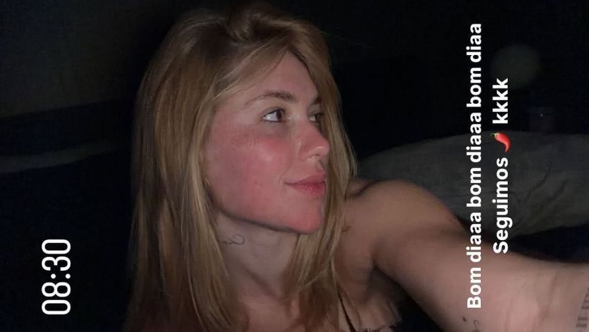 Virginia faz procedimento a laser para tratar espinhas • Reprodução/ Instagram