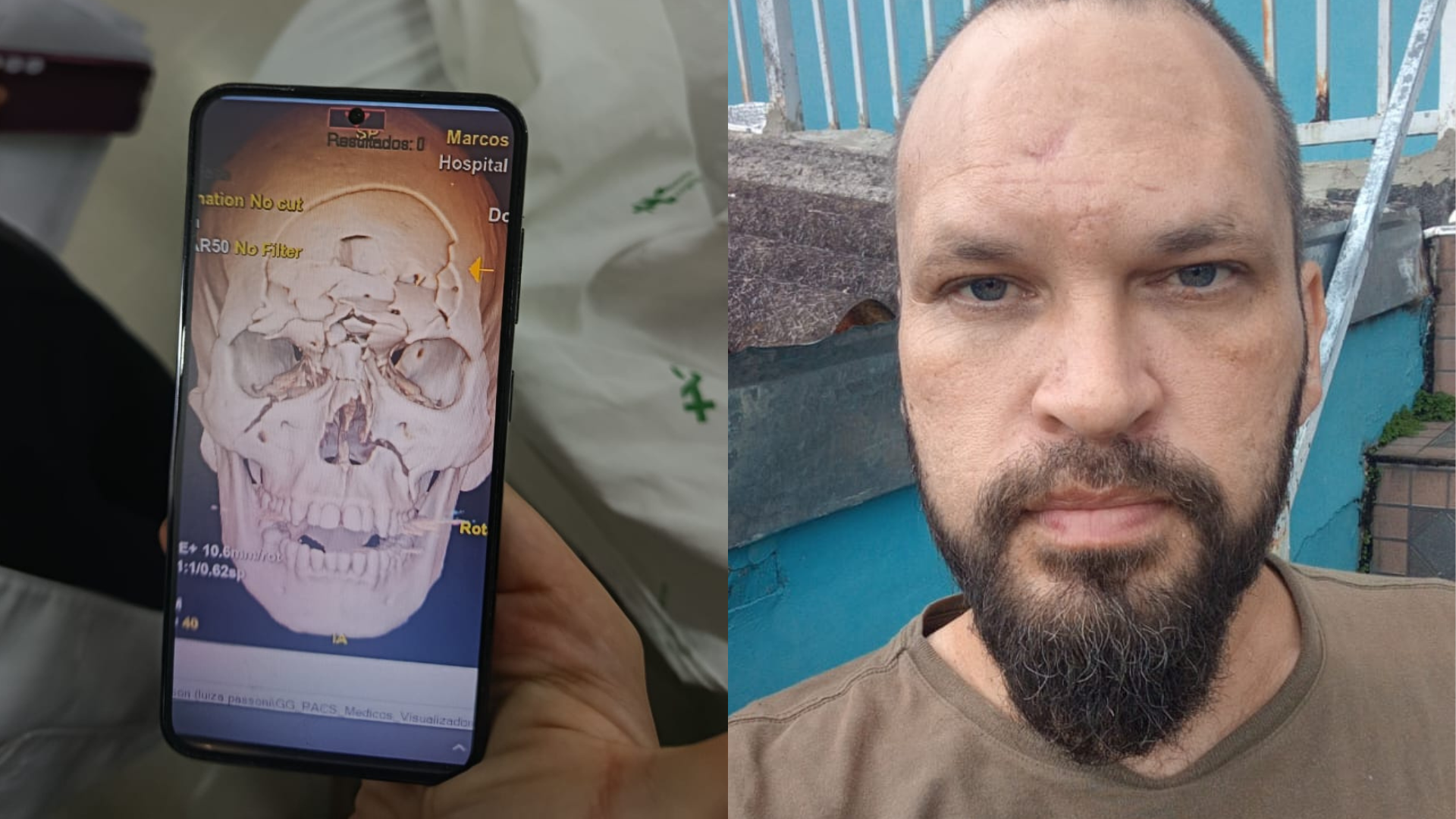 Motociclista tem crânio “triturado” em acidente e passa por cirurgia de reconstrução